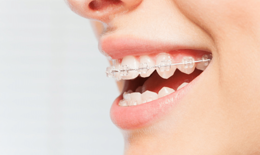 Featured image for “5 Tips for Oral Hygiene During Your Orthodontic Treatment”