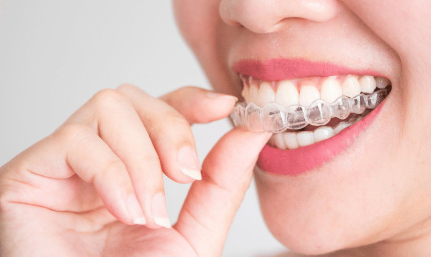 Invisalign Roseville - Dunn Orthodontics