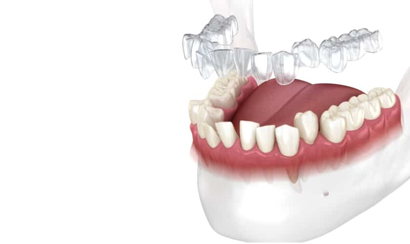 Featured image for “Invisalign Common FAQ: Answering Your Burning Questions”