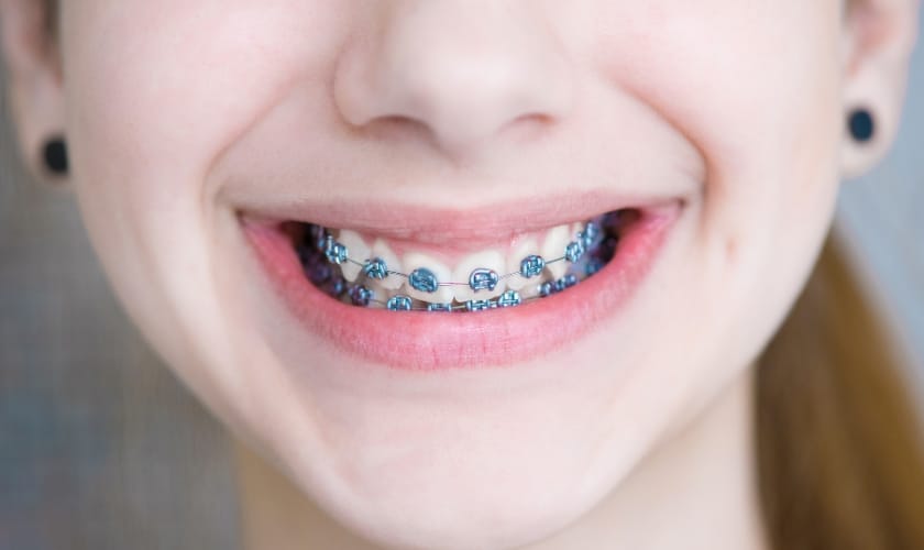 Featured image for “Understanding the Different Types of Braces: Which Is Right for You?”