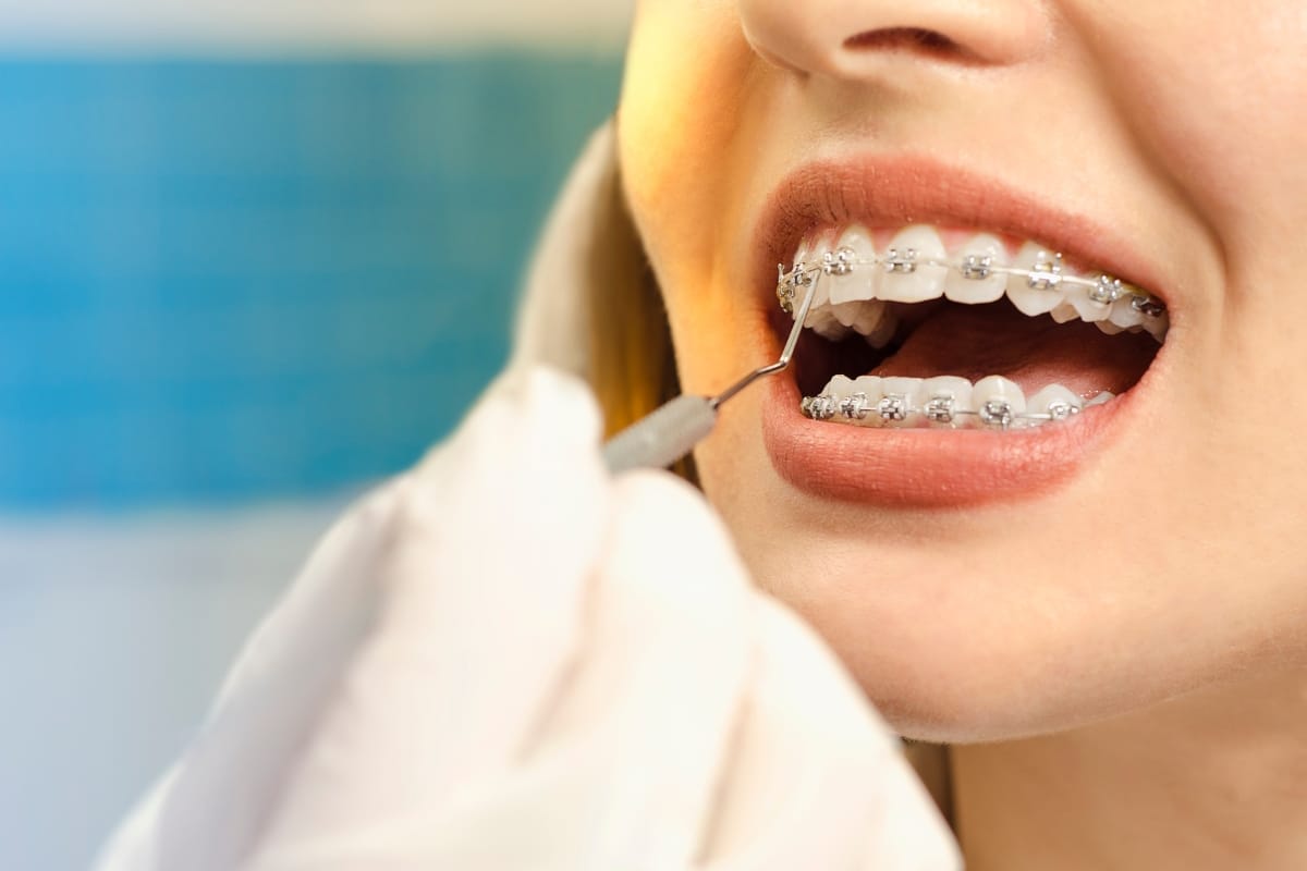 Essential Tips: What Not to Do After Getting Braces Off