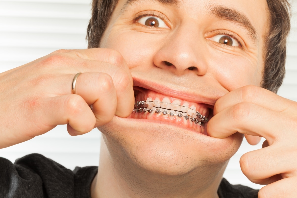 Featured image for “What to Do If a Braces Wire Breaks: Emergency Tips”