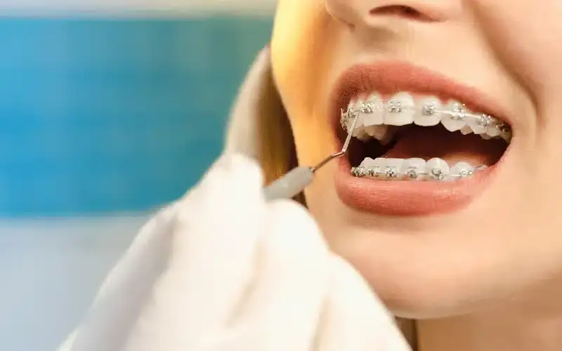 Ways to Keep Your Braces Clean During the Winter Season