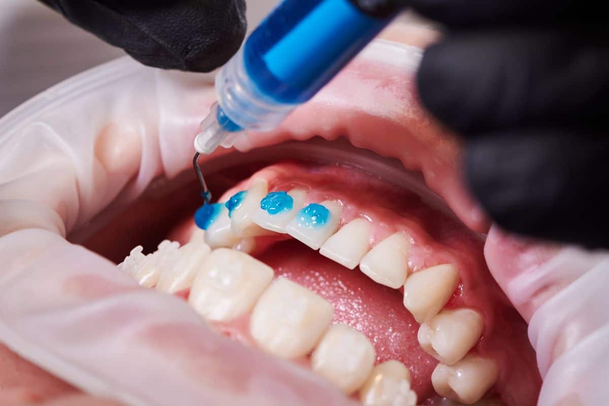 Braces Procedure.