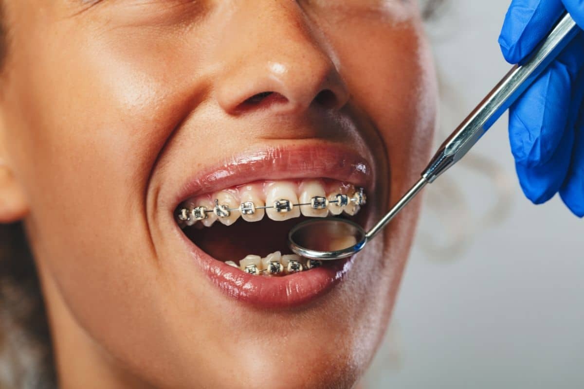 Close-up of a patient with braces undergoing a dental checkup.