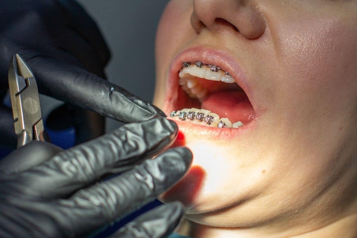 Patient receiving orthodontic treatment for long-term dental health.