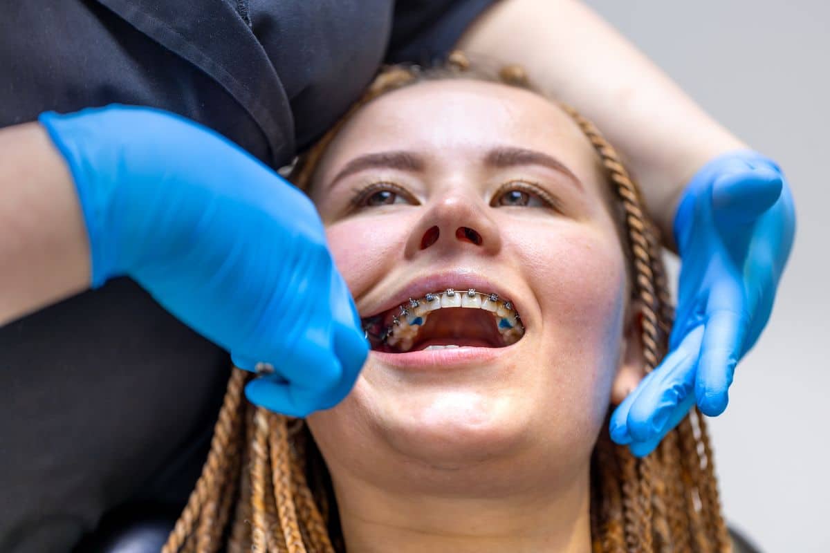 Featured image for “How To Prepare For Your First Braces Appointment?”