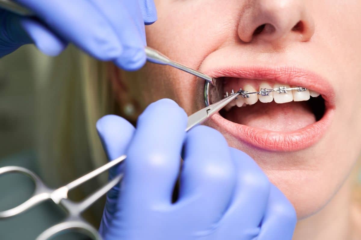 Featured image for “How Long Does It Take for Braces to Close Front Tooth Gaps?”